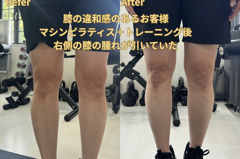 マシンピラティス＋パーソナルトレーニングで右側の膝の腫れが無くなった！ - 2